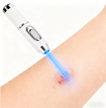 Generación-2 Láser dice adiós a todas las verrugas en 7 días